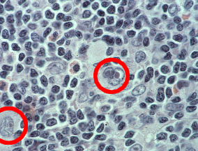 Hodgkin cells and Reed-Sternberg cells
